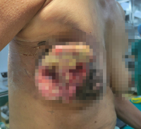 Tự đắp lá, uống thuốc nam chữa ung thư vú, nữ bệnh nhân ở Hà Nội bị loét da, chảy dịch, suy kiệt