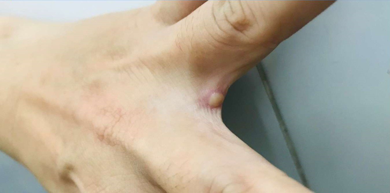 Bóng nước điển hình rải rác các vị trí khác nhau trên cơ thể người bệnh đậu mùa khỉjpeg