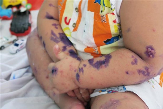 Đặc trưng của bệnh tay chân miệng là nổi mụn nước xung quanh miệng tay và chân. Ảnh Đinh HằngTTXVN